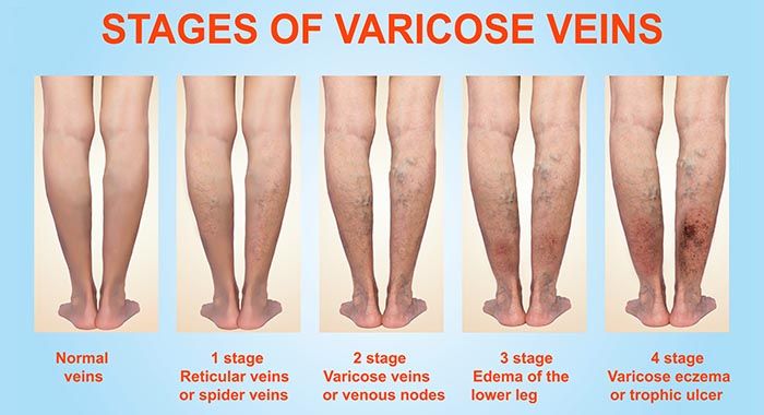 varicose veins stages